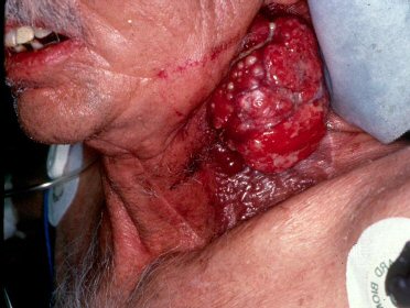 20070704122608-tumor-neck.jpg